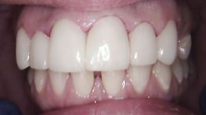 Aligned dentures