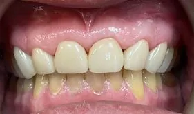 Clean dentures