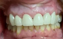 After correction of dentures