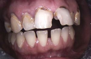 Misaligned dentures