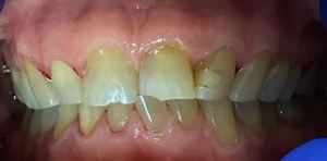 Unclean dentures