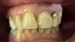 Picture of dentures