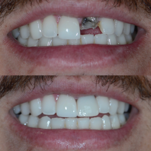 Before and after teeth replacement