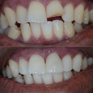 Before and after teeth correction